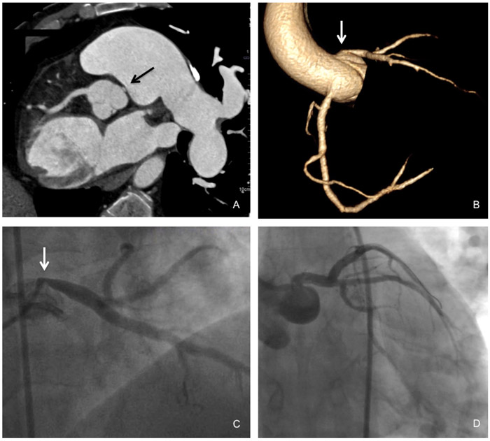 When breathlessness meets chest discomfort