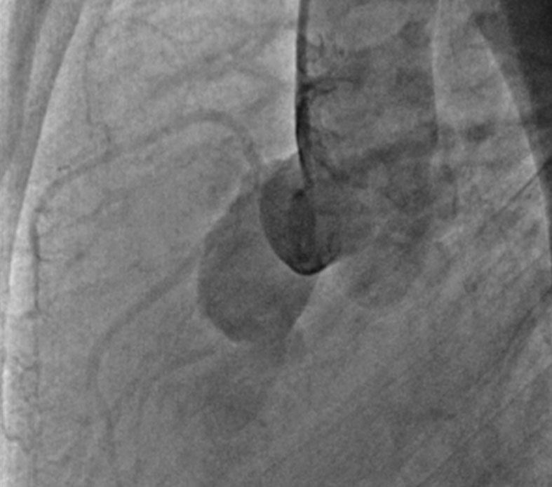 Multimodality imaging in cardiology unveils the rarest diagnostic possibilities!