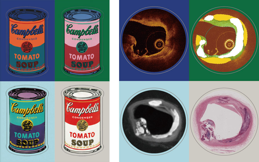 Pop art perspective: A coronary conundrum