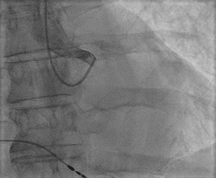 The mystery of the vanishing coronary artery: a shocking angiographic revelation