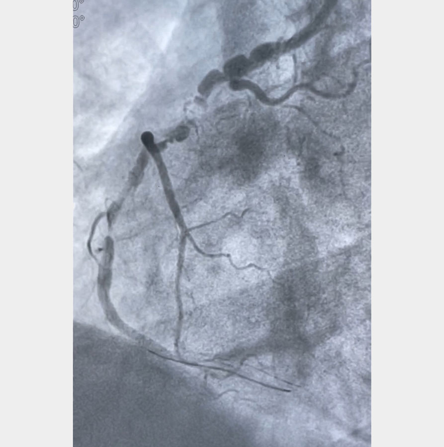 What is it with that crumpled coronary: a lesion or a pseudo-lesion? 