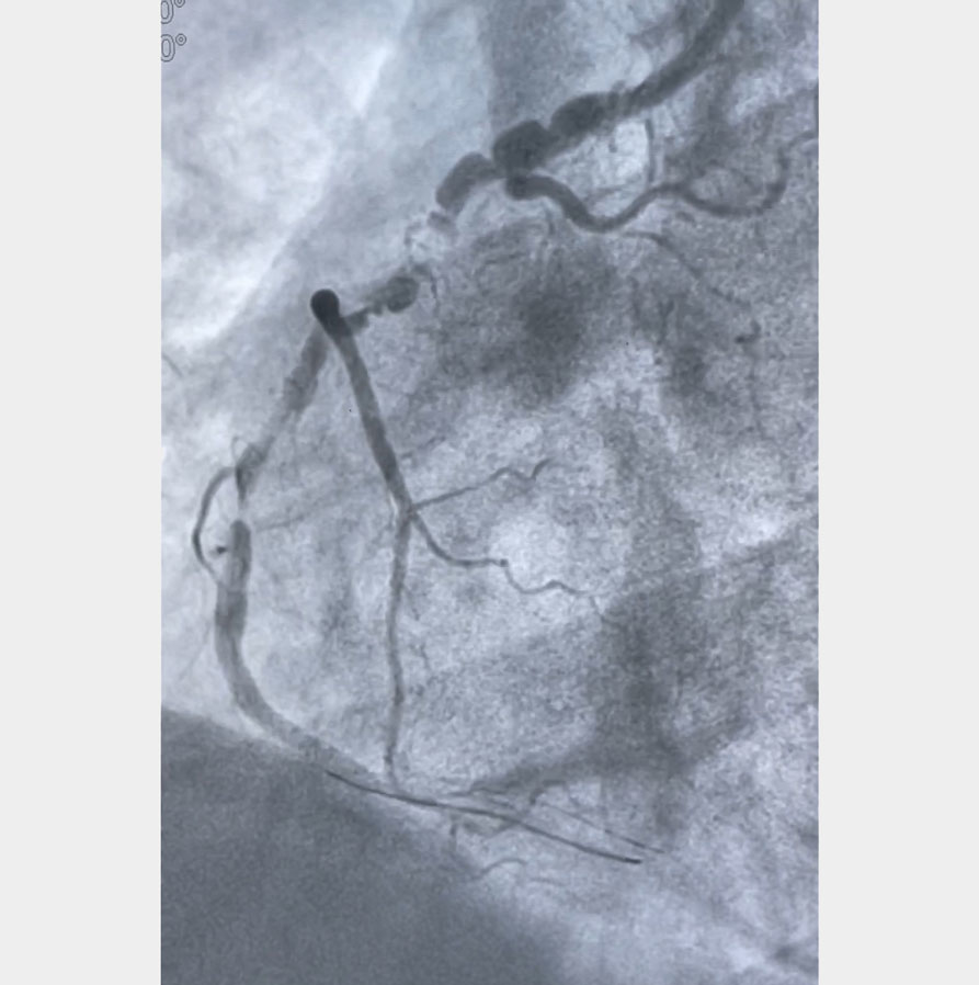 What is it with that crumpled coronary: a lesion or a pseudo-lesion? 