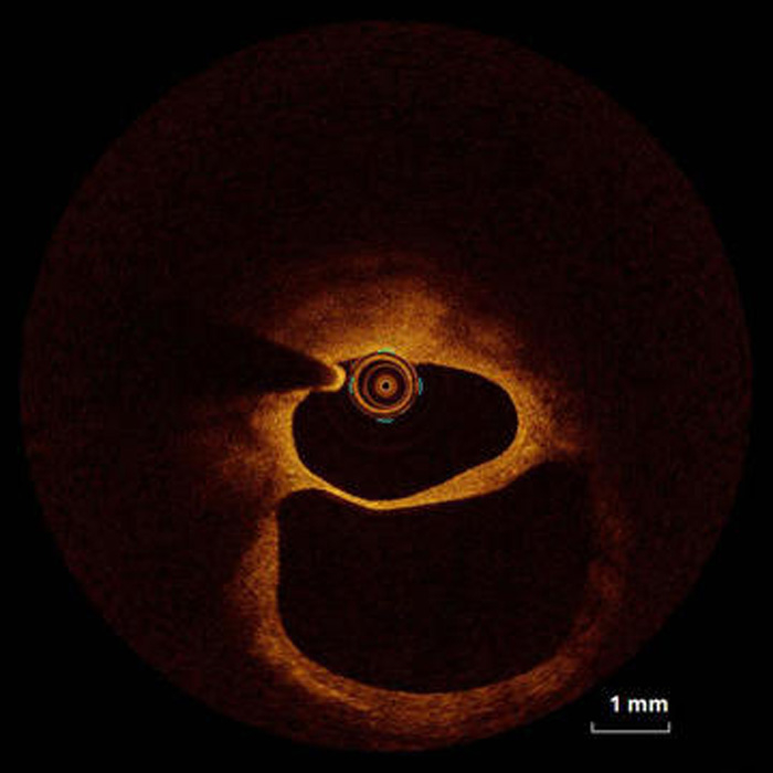 When imaging resolves the dispute on angiography 