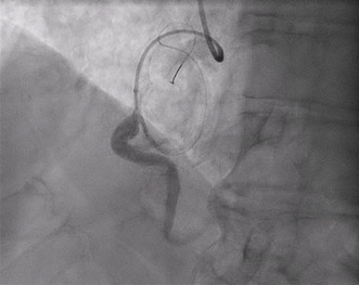 A coronary surprise: anatomy you don’t expect