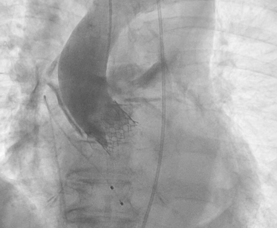 A dreaded complication