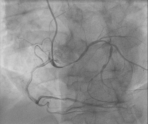 A female patient with an out-of-hospital cardiac arrest