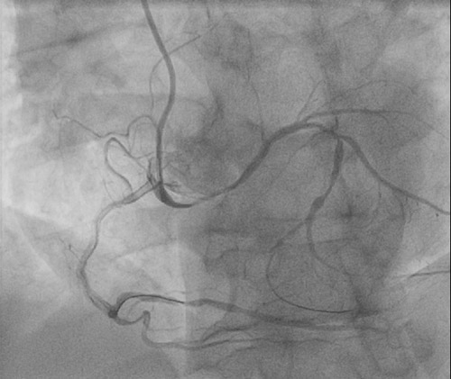 A female patient with an out-of-hospital cardiac arrest