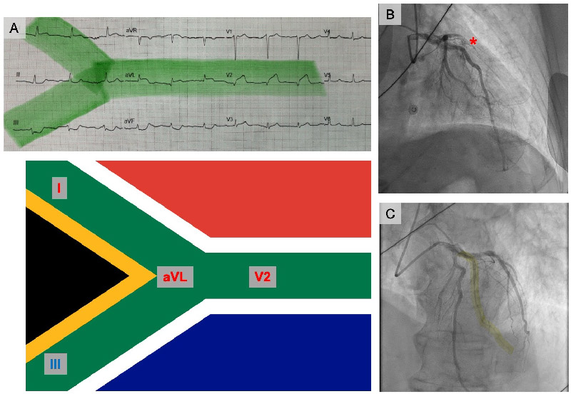A journey toward a paradisiacal destination in the cath lab