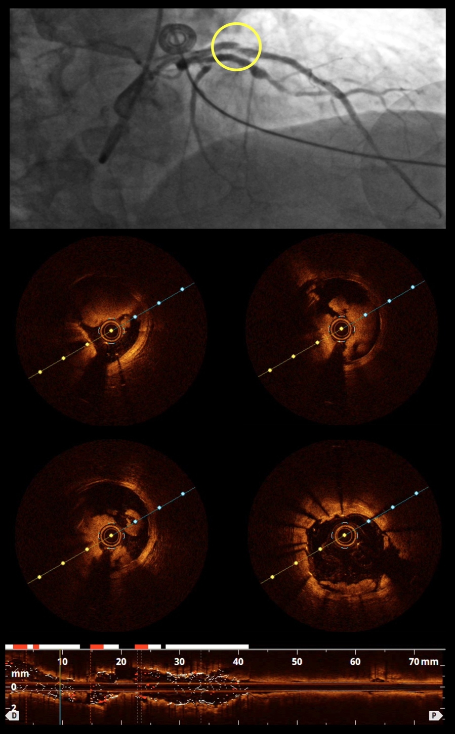 A perfect angiographic result until it wasn't