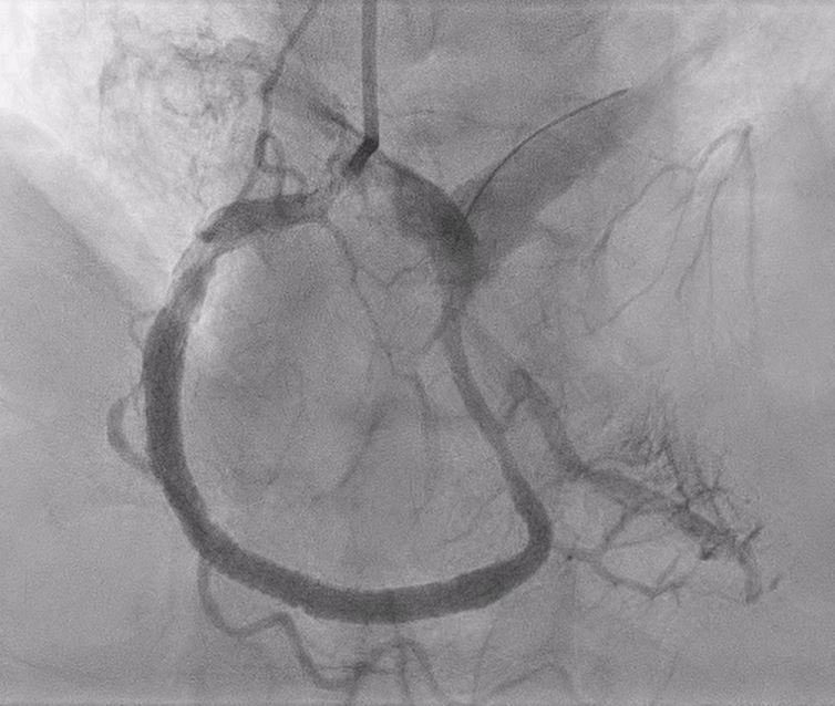 A surprise uncovered after revascularisation of inferior STEMI