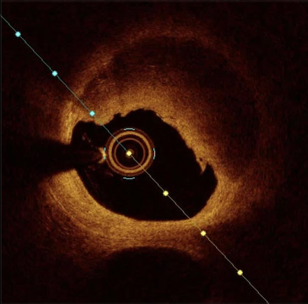 Acute coronary syndrome in the young