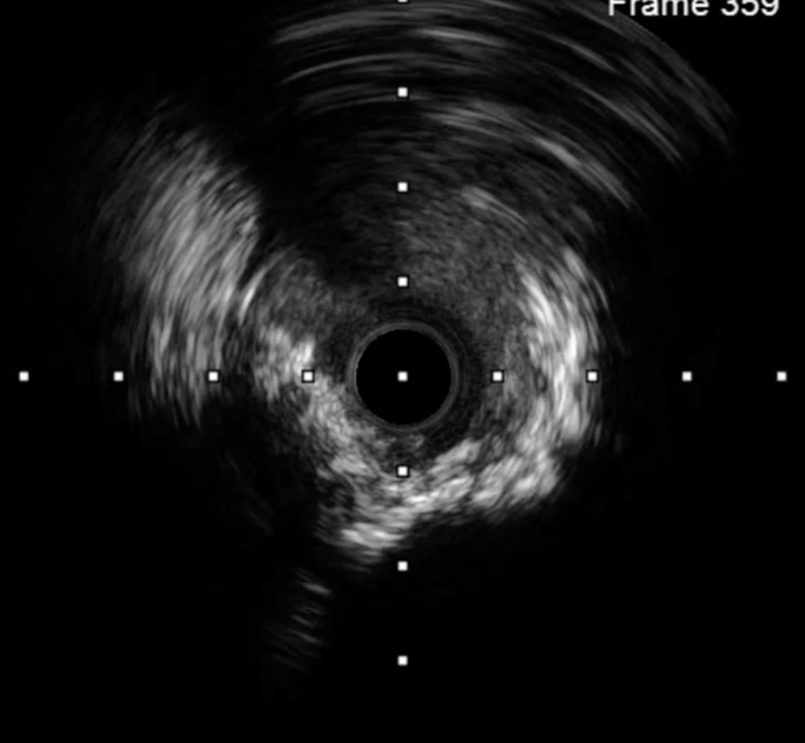 Acute coronary syndrome with resuscitated cardiac arrest