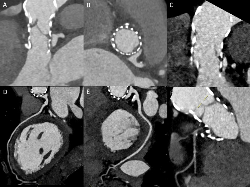 An acute coronary syndrome with severe global myocardial ischemia 6 months after TAVI