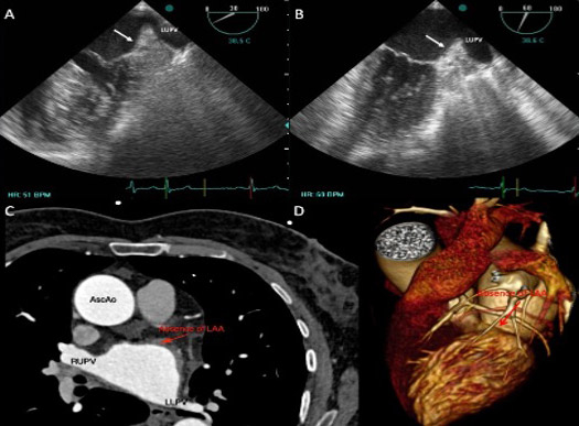 An anatomical ghost in the left atrium
