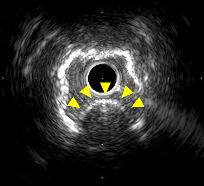An unexpected finding during a complex coronary intervention