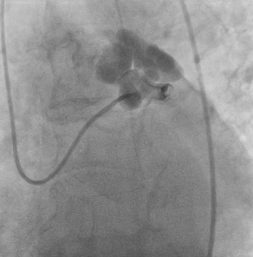 An unusual coronary shortcut - When nature takes an unexpected turn