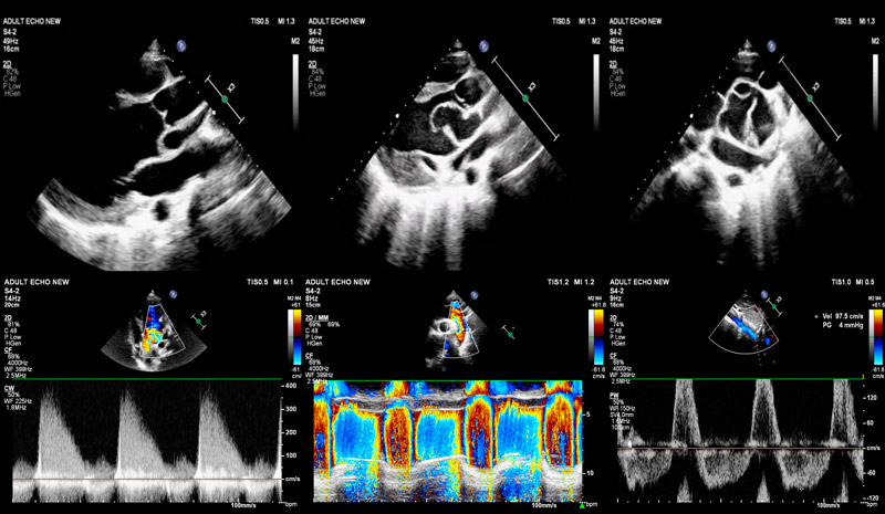 Aortic root illusions