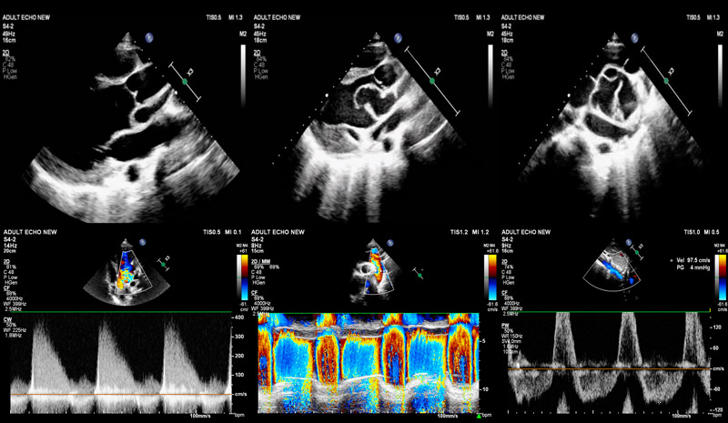 Aortic root illusions