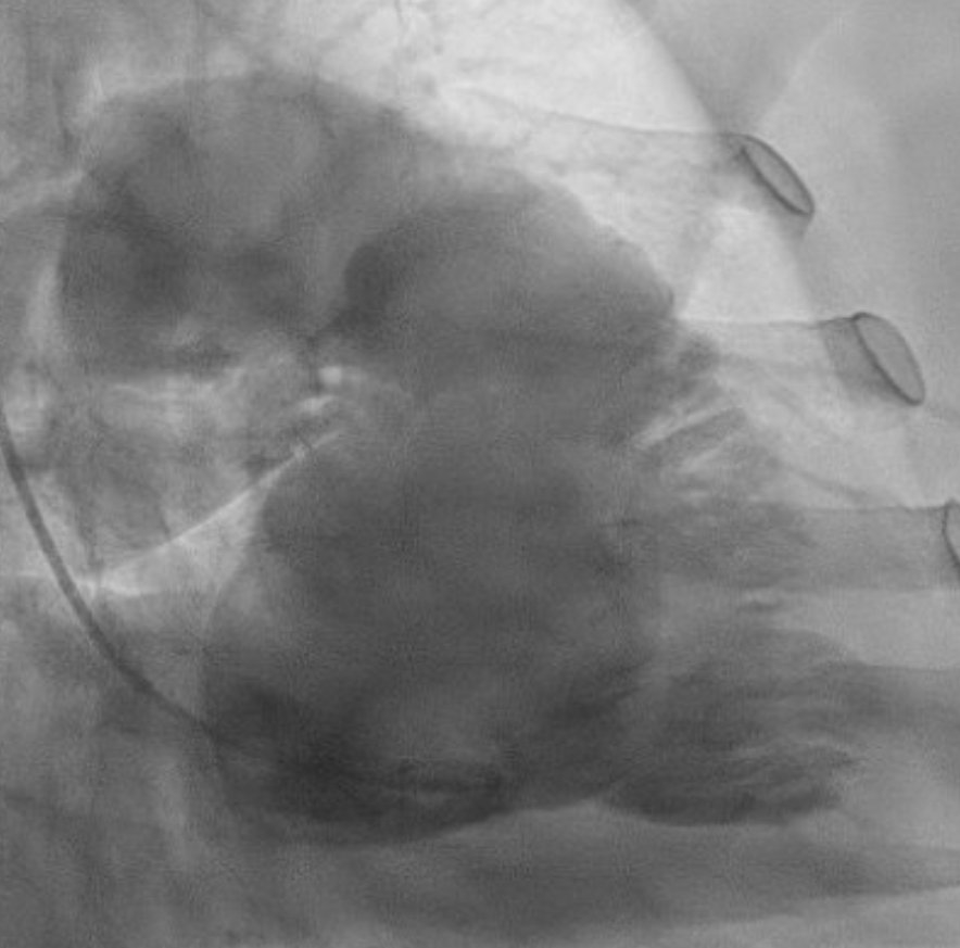 Atypical angina and unusual right ventricular motion: The indispensable role of ventriculography