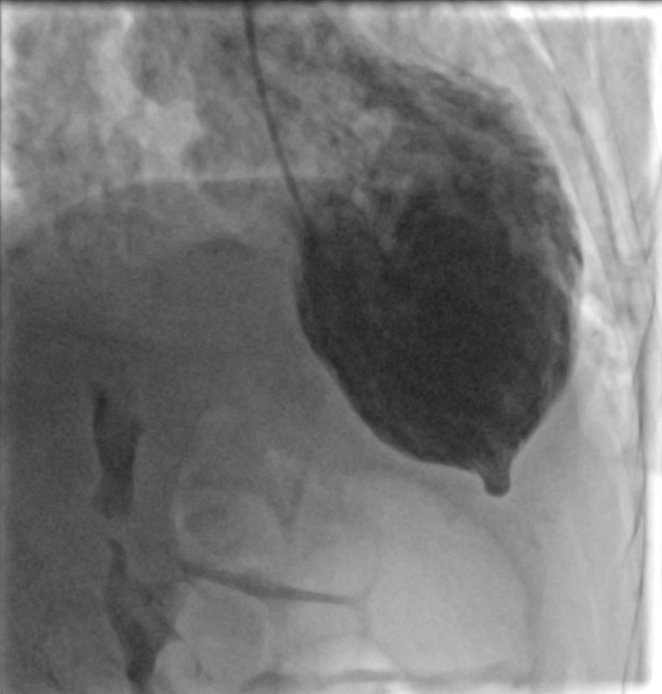 Cardiogenic shock with a twist