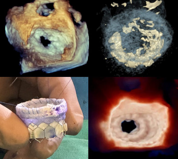 Creative valve preparation for a challenging mitral anatomy