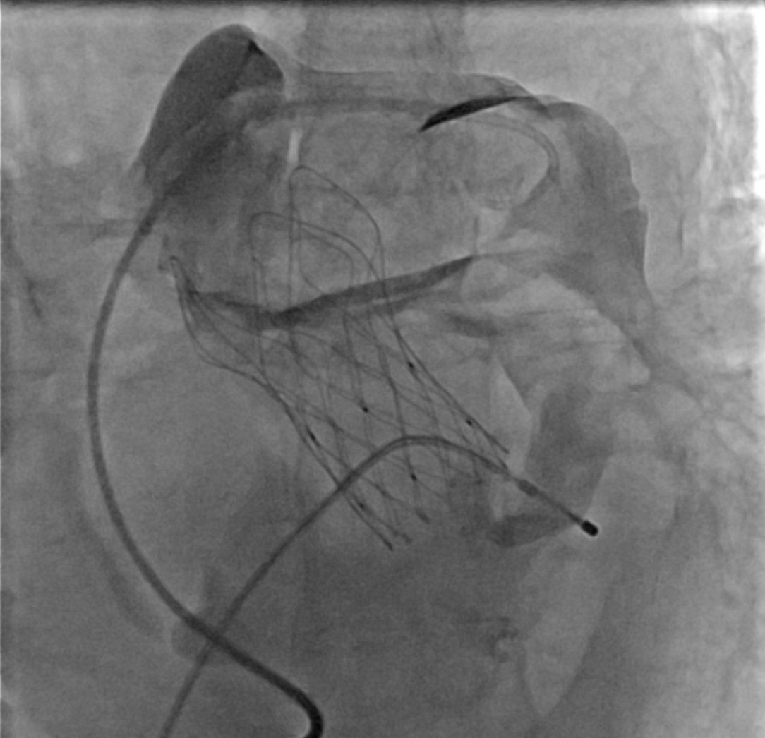 Crossing the line: A fatal step in TAVI