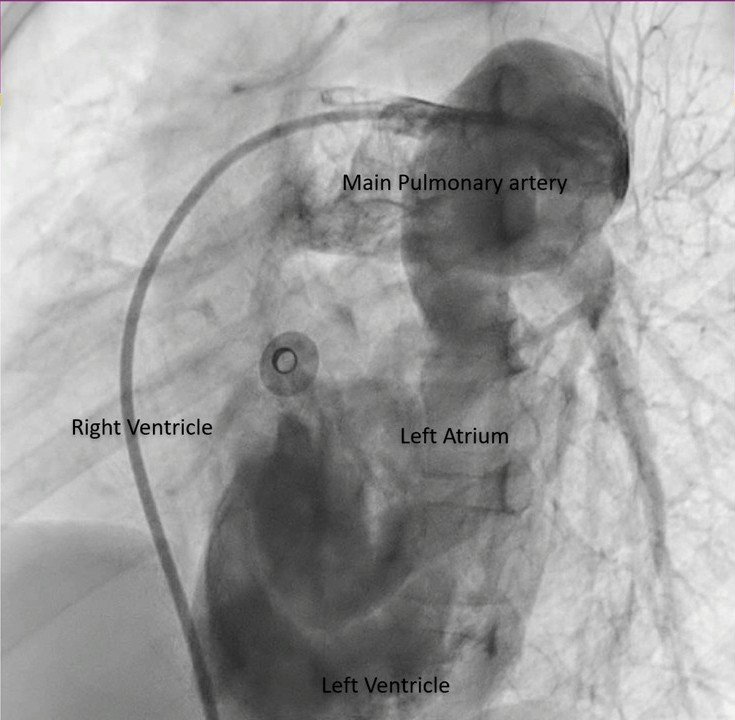 Cyanosis since birth in a child with a structurally normal heart