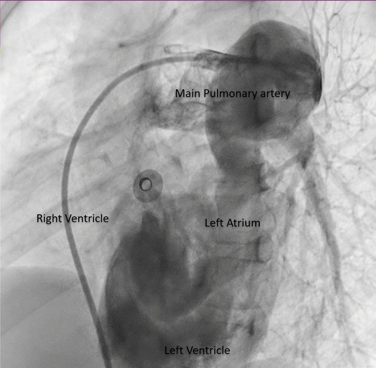 Cyanosis since birth in a child with a structurally normal heart
