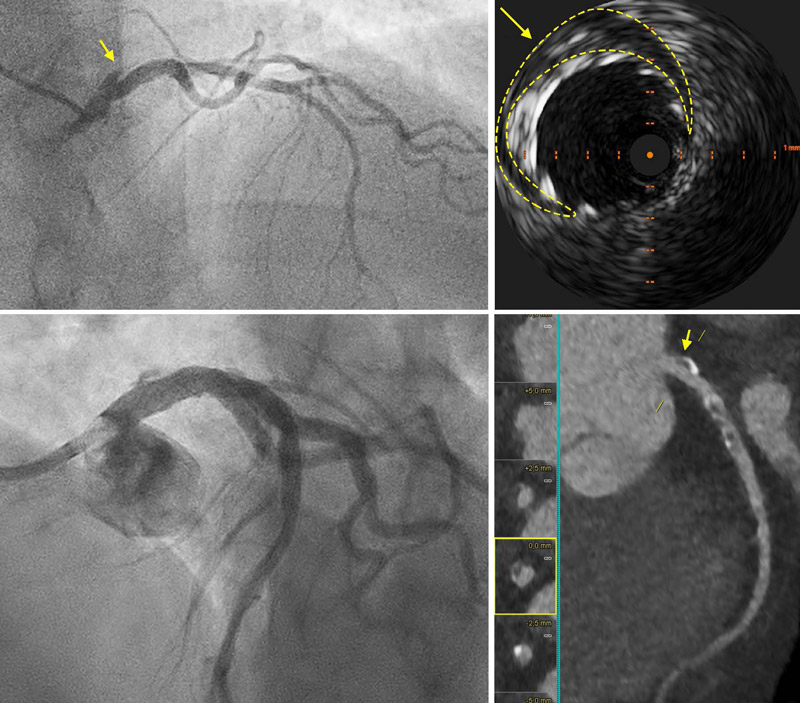 Danger alert on a CT coronary angiogram