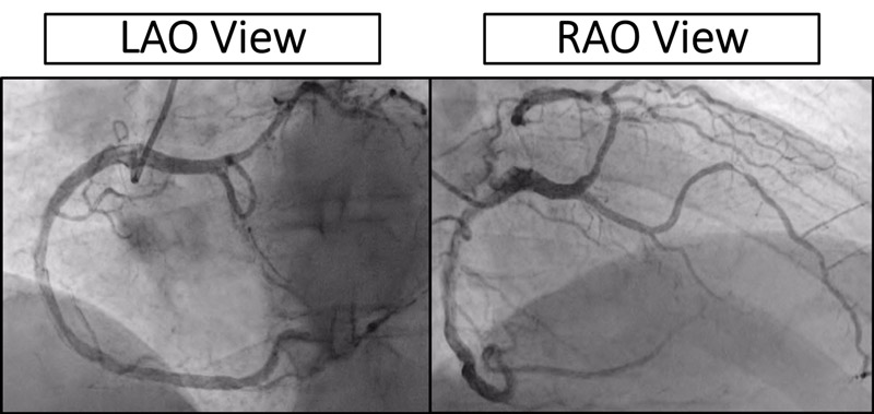 Decode the course of this anomalous left main from right coronary cusp ?