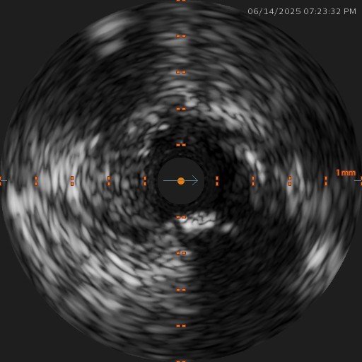 Haziness in ostial left circumflex artery