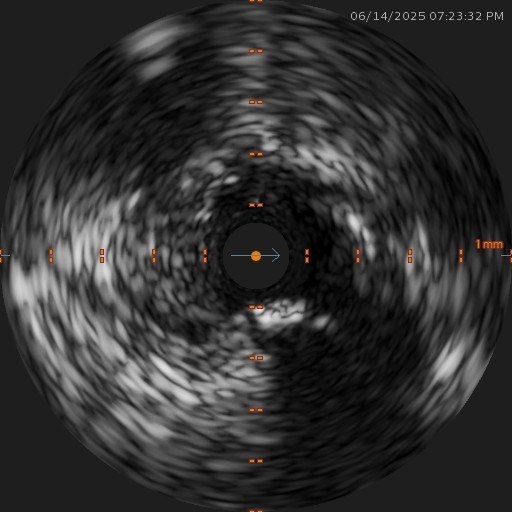 Haziness in ostial left circumflex artery