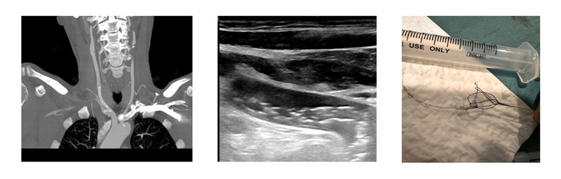 Importance of multimodality imaging in coronary interventions