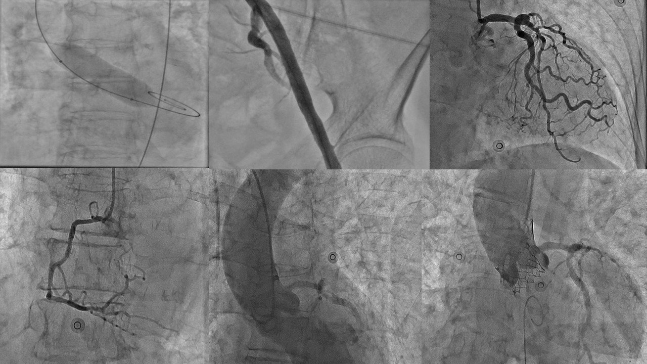 Importance of vigilance in the cathlab 