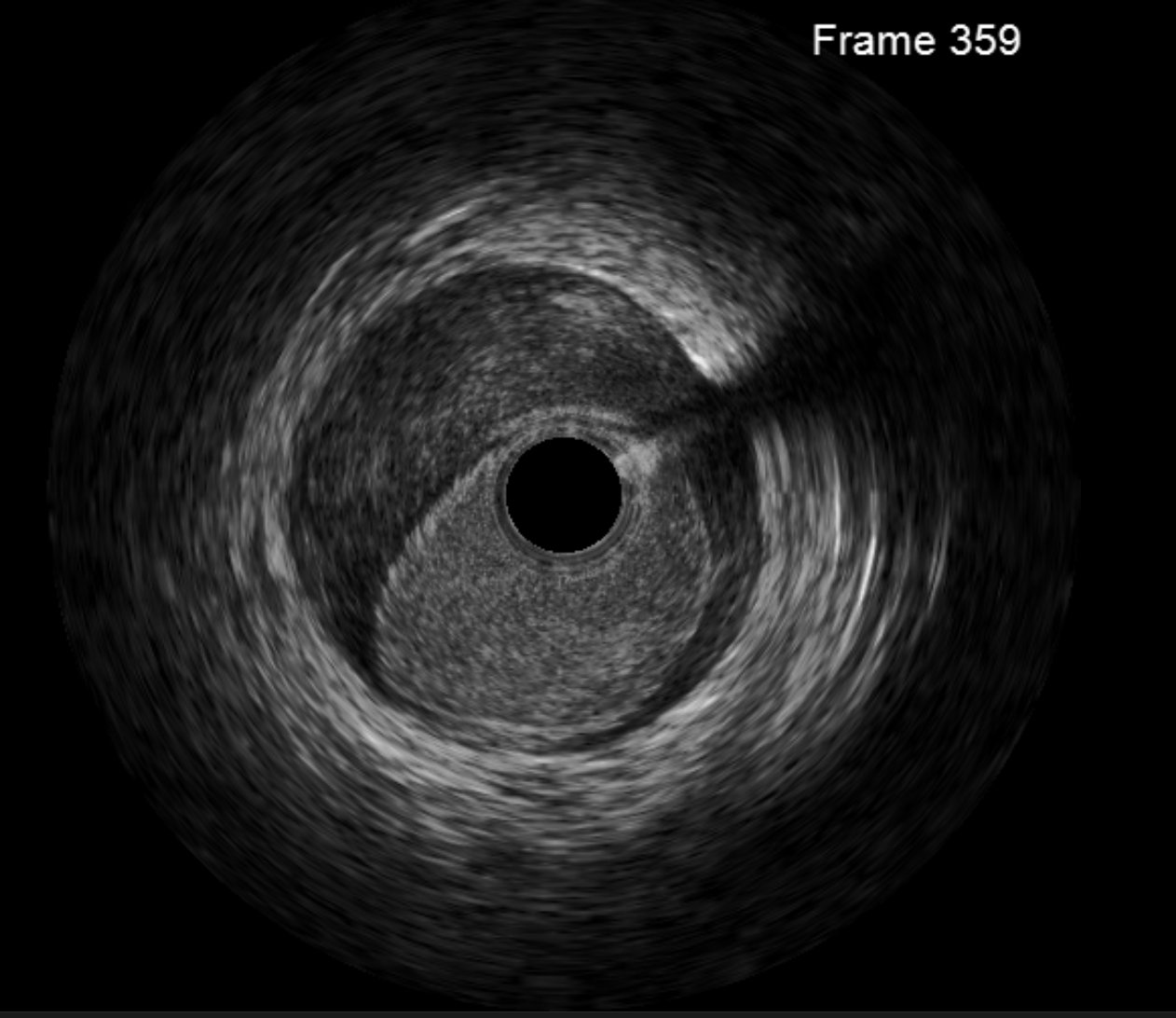 Intravascular ultrasound (IVUS) of the LAD