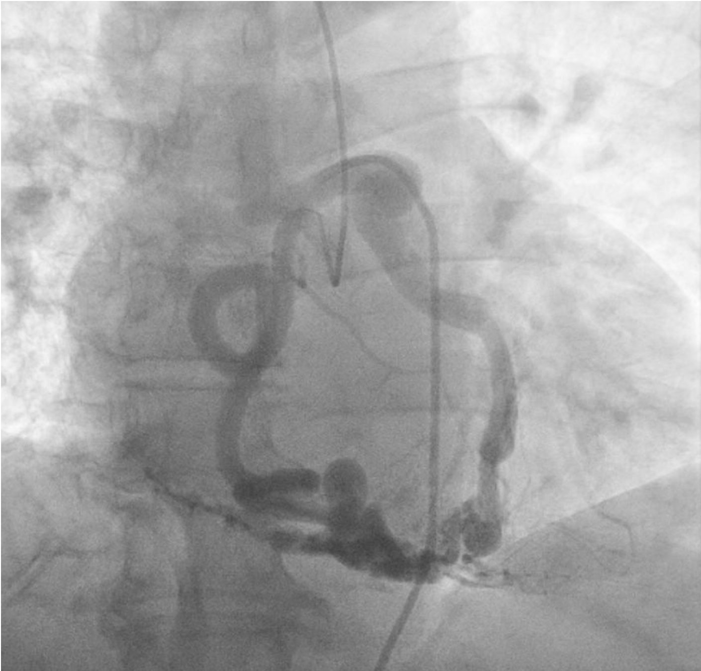 It was just a dyspnea study...