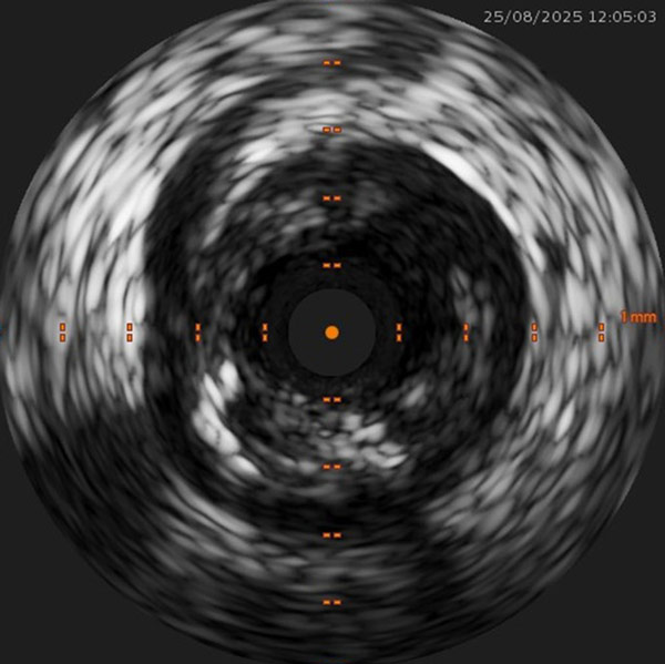 IVUS usage for diagnosis outside the coronaries
