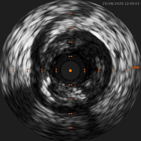 IVUS usage for diagnosis outside the coronaries