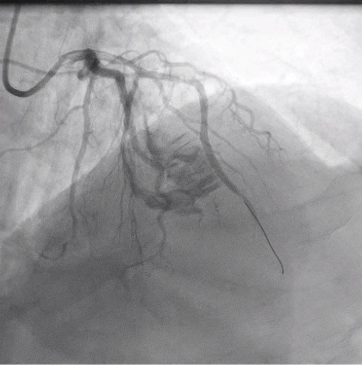 Massive perforation after balloon dilation of coronary artery without hemodynamic compromise