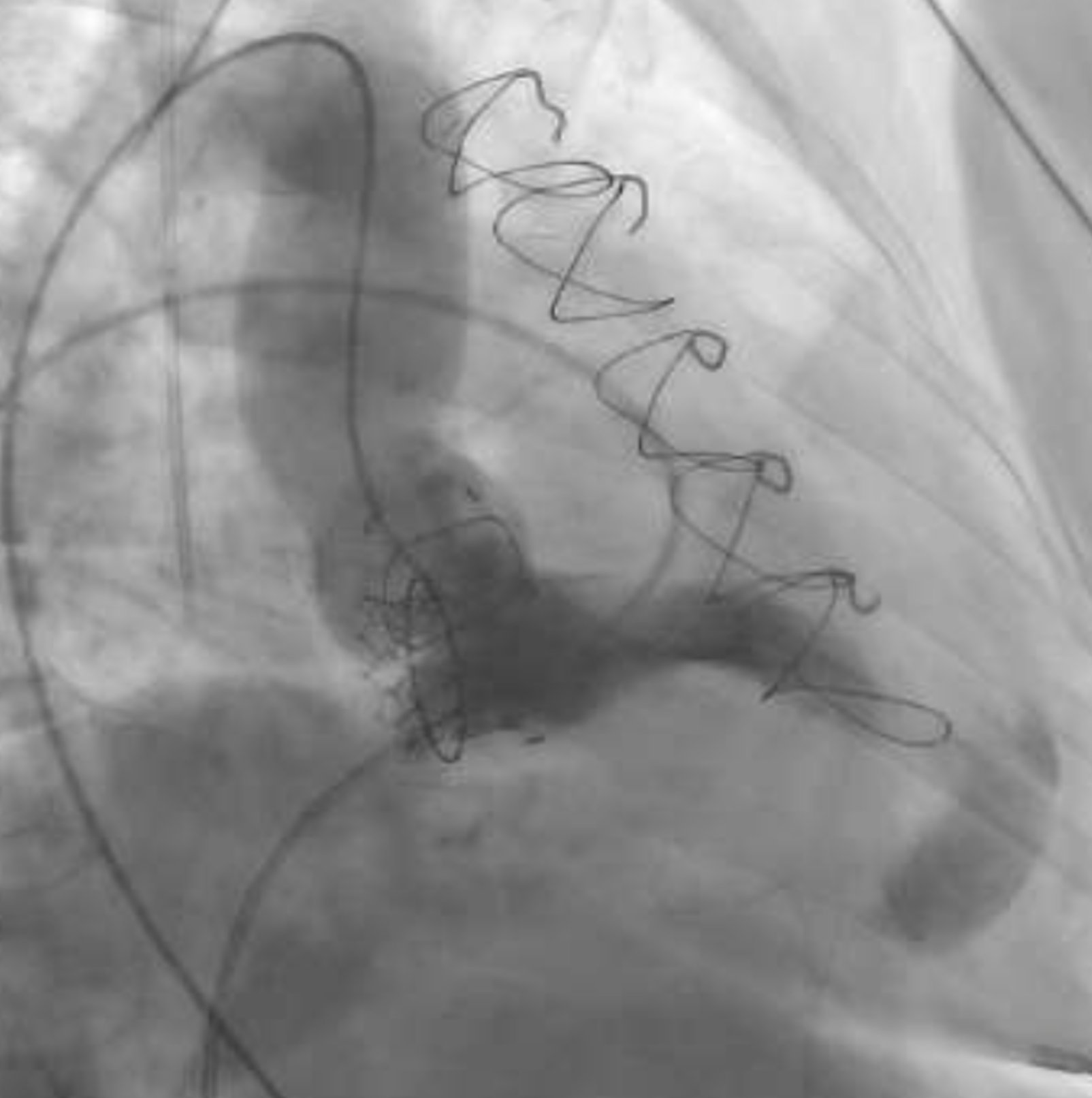 My first horror in a Cathlab