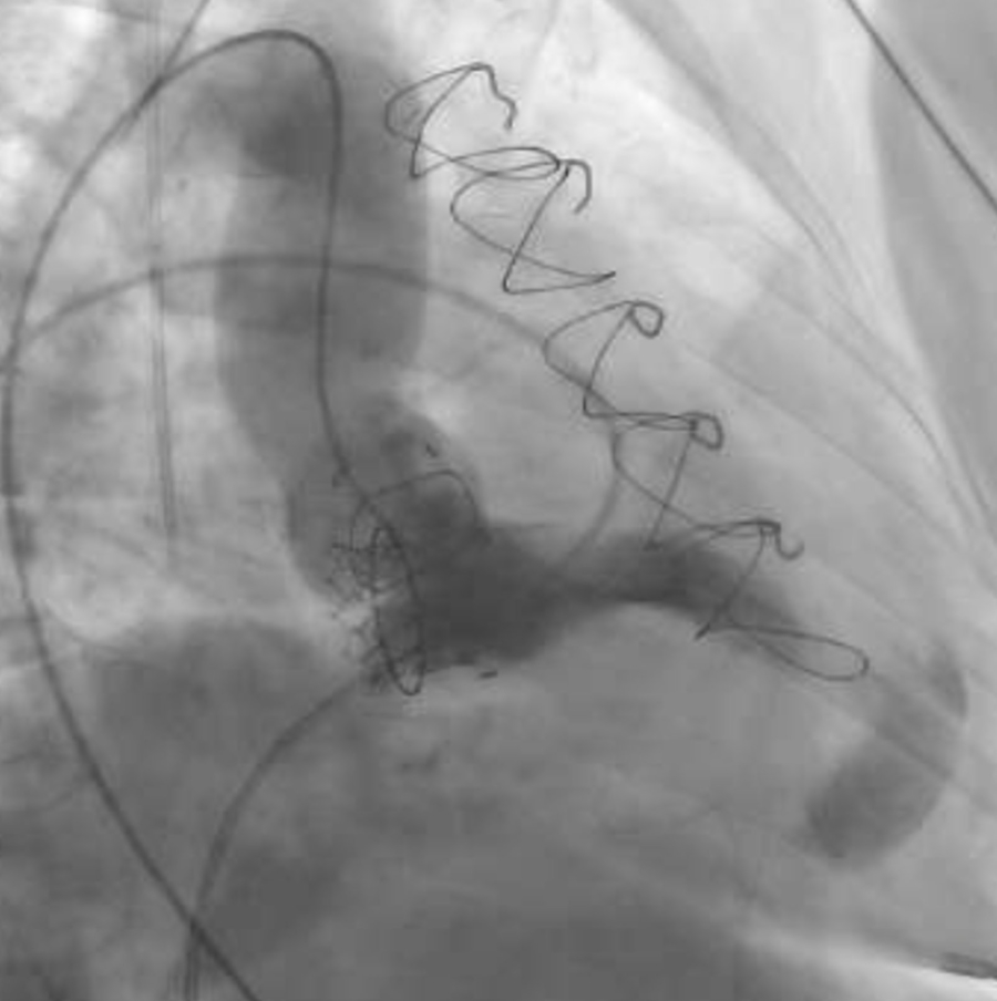 My first horror in a Cathlab