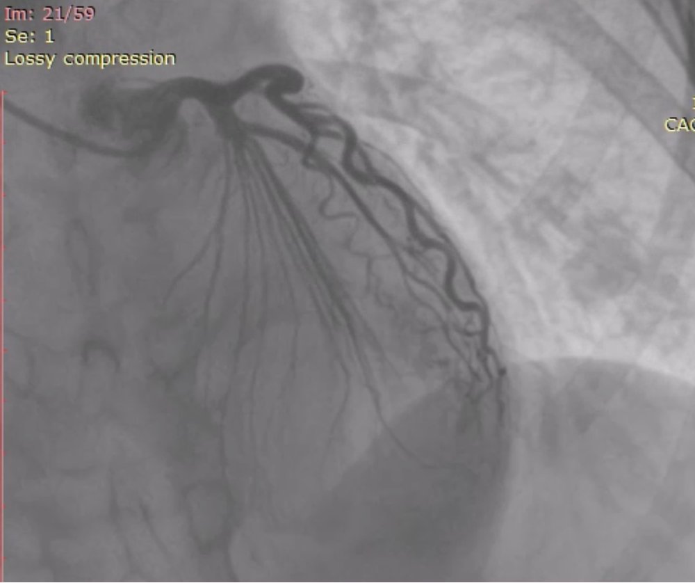 Mysterious coronary artery 