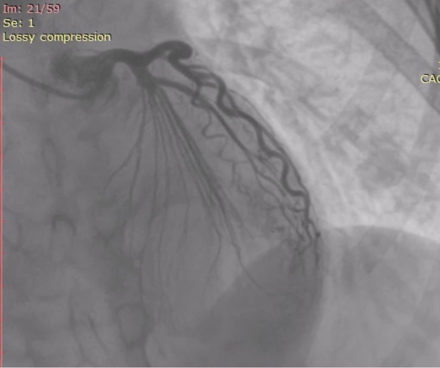 Mysterious coronary artery 