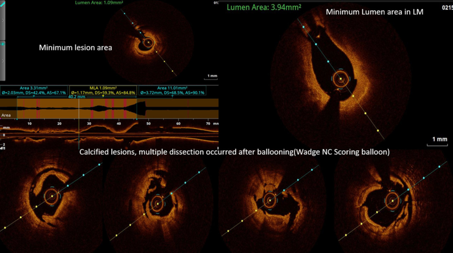OCT-guided plaque modification in severe coronary calcification
