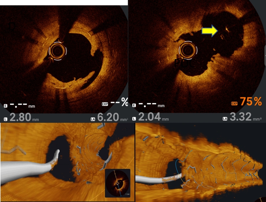 OCT image of bifurcation lesion