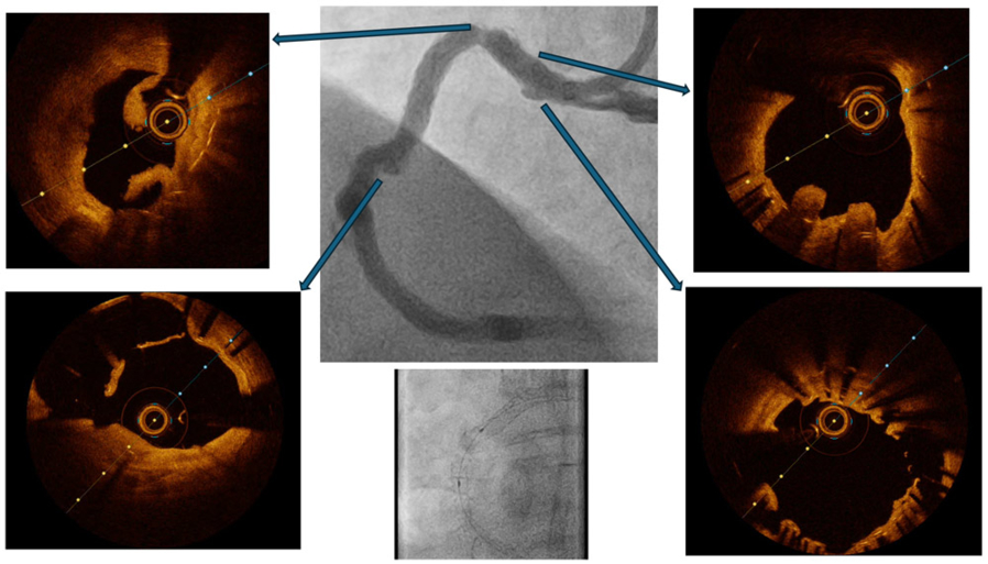 OCT insight in a case of recurrent inferior wall MI and stent failure
