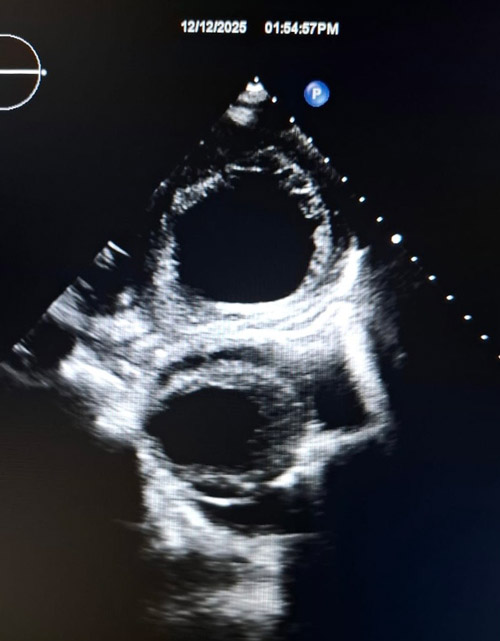 Parasternal short-axis view demonstrating two pulsatile cavities 