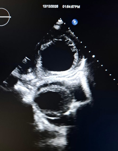 Parasternal short-axis view demonstrating two pulsatile cavities 
