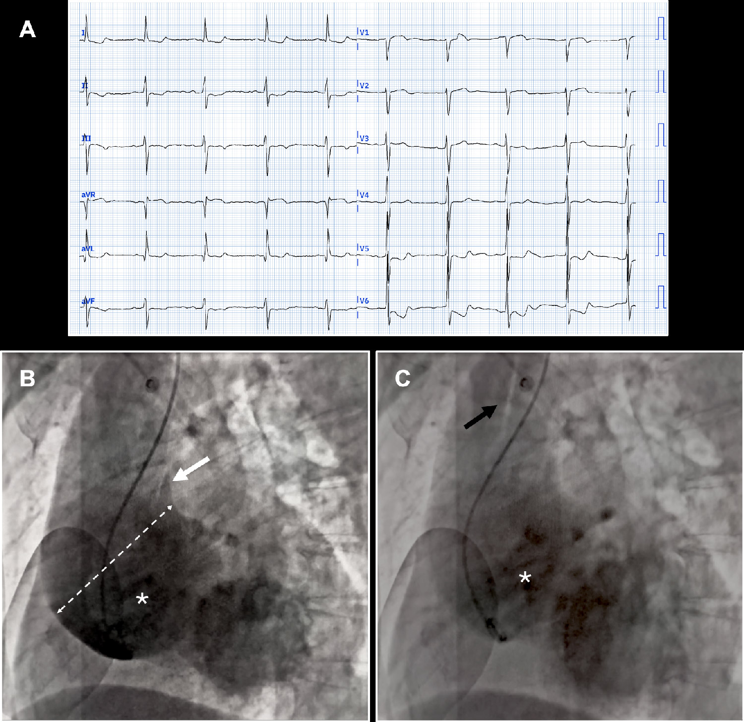 Routine angio...but where are the coronary ostia?