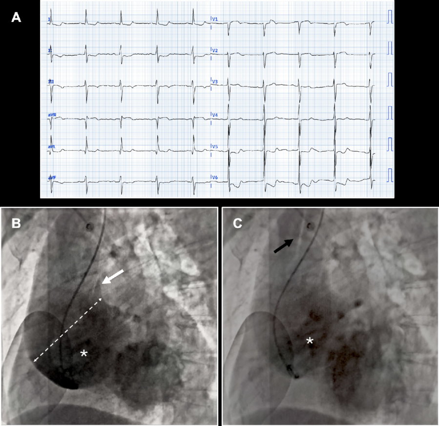 Routine angio...but where are the coronary ostia?